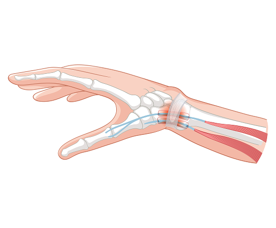 Tendinitis & Tendinosis