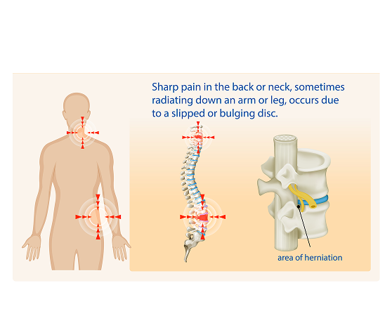 Disc Herniation