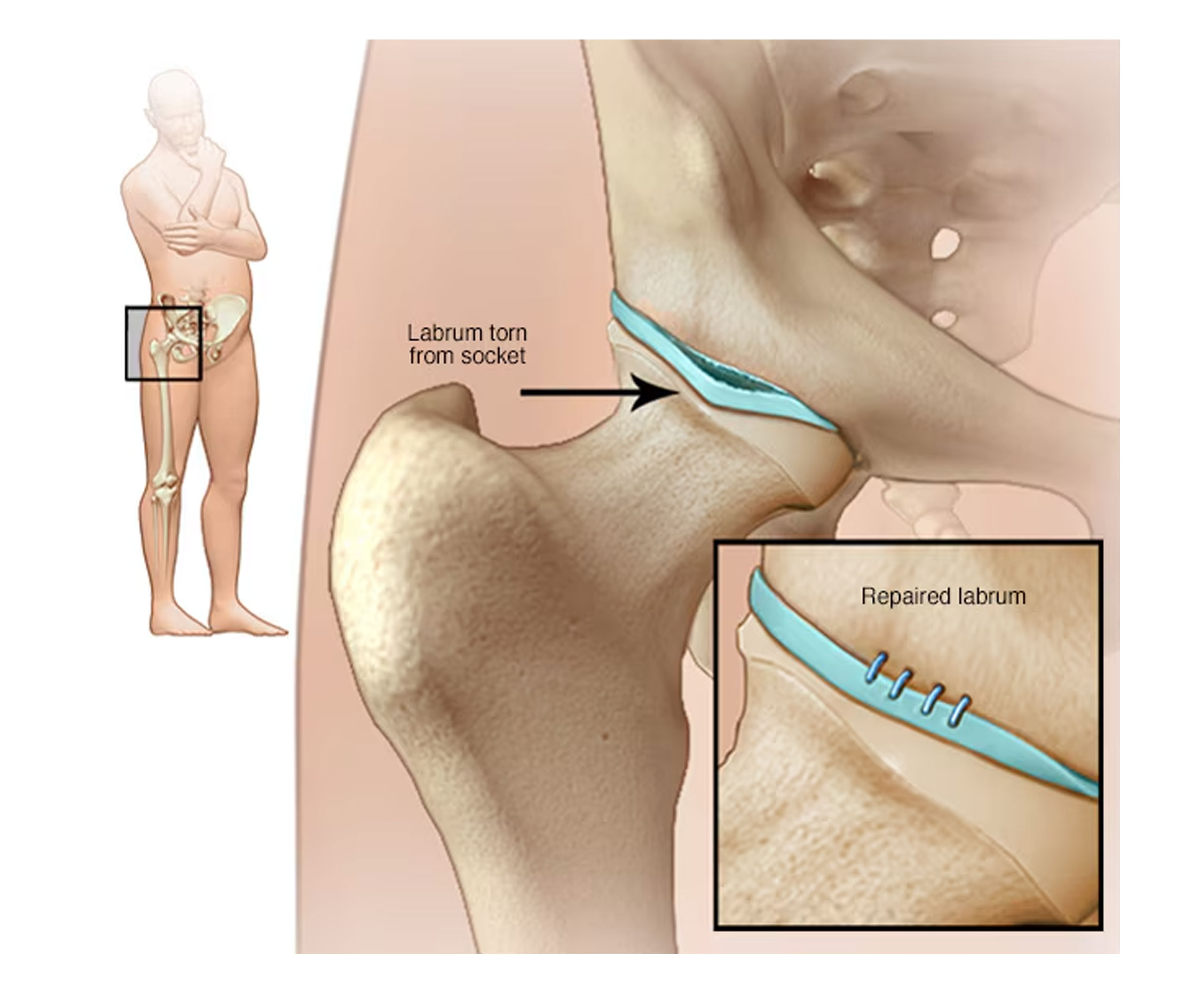 Hip-Labral-Tears