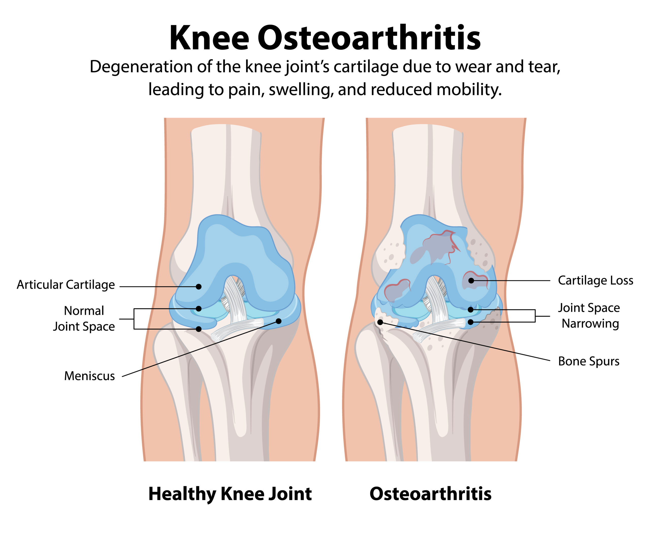 Knee-Osteoarthritis