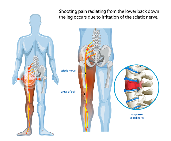 Sciatica