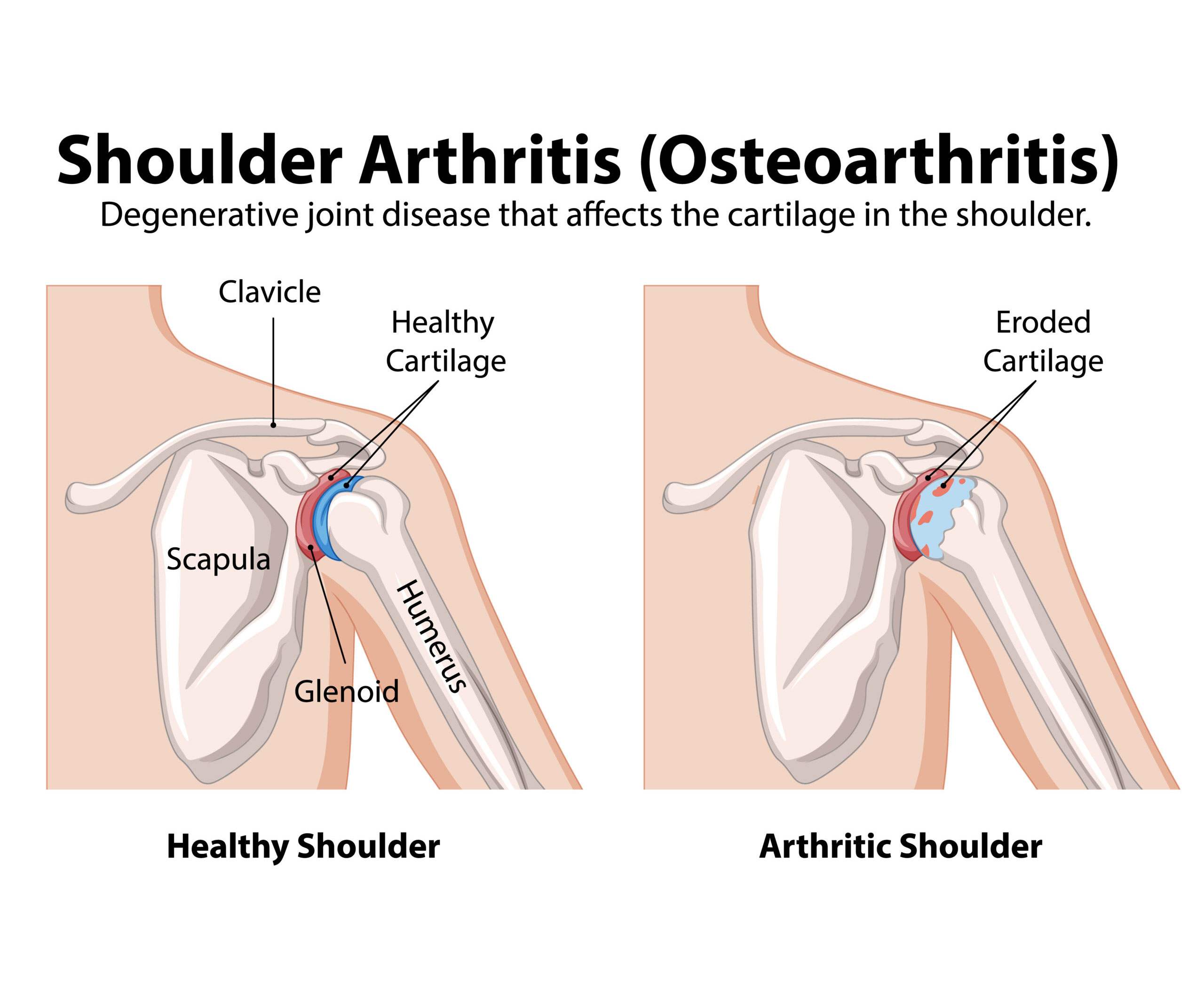 Shoulder-Osteoarthritis