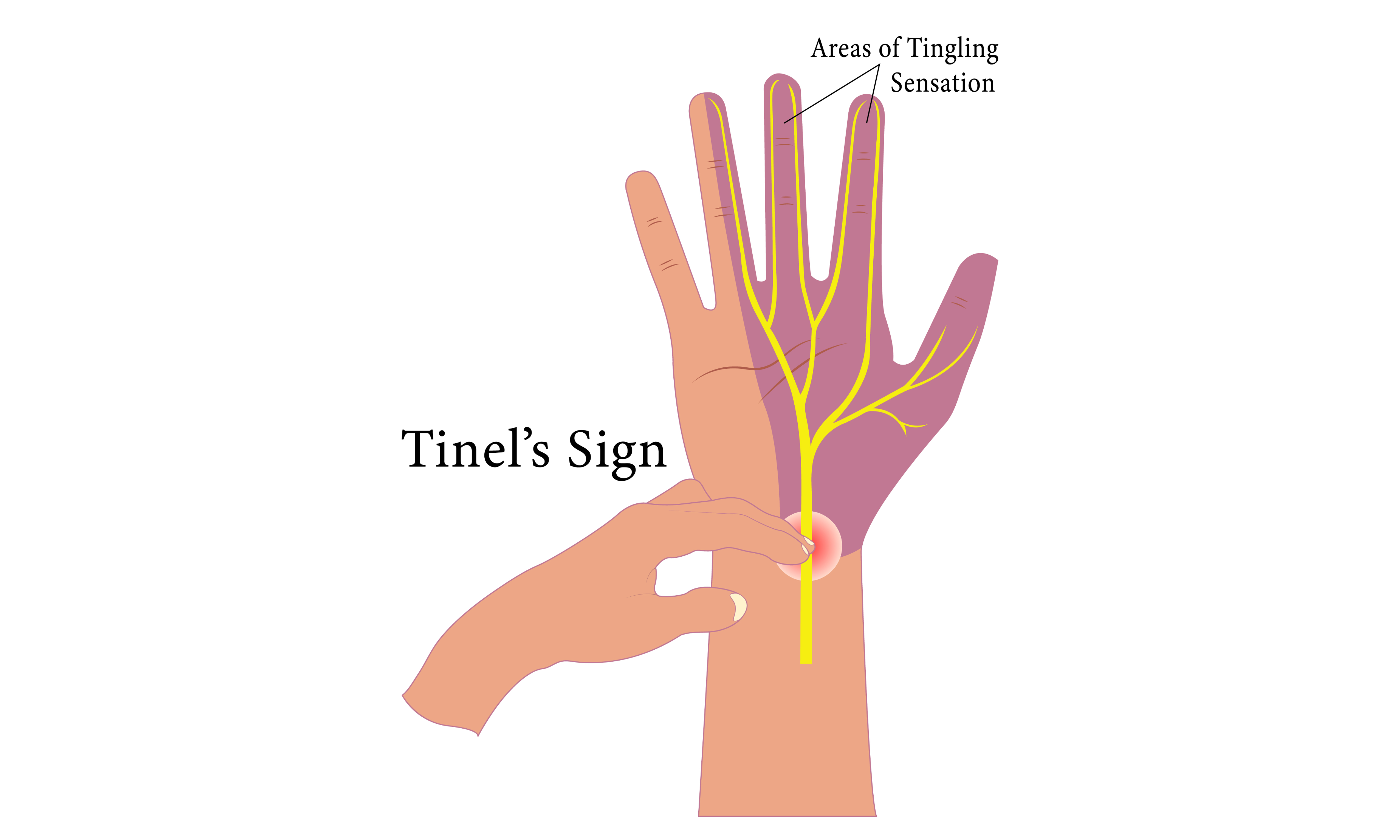 Wrist/Hand OA & Joint Pain