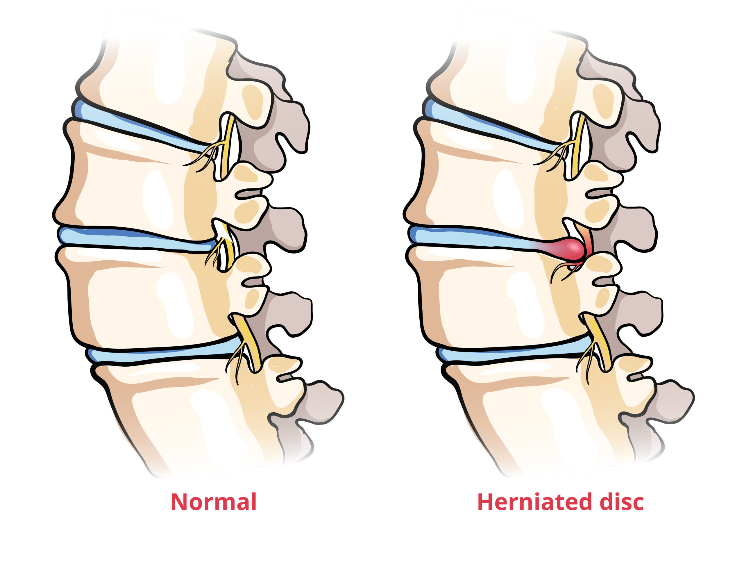 Disc Herniation